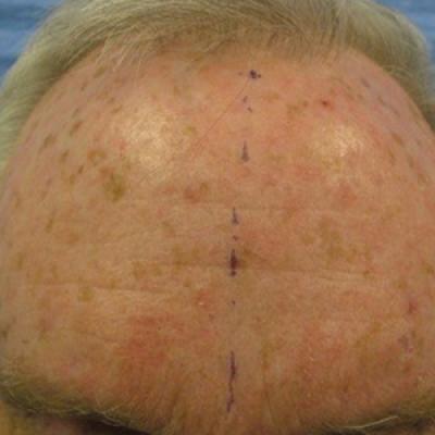 CO Laser Ablative Fractional Resurfacing Photodynamic Therapy For Actinic Keratosis And